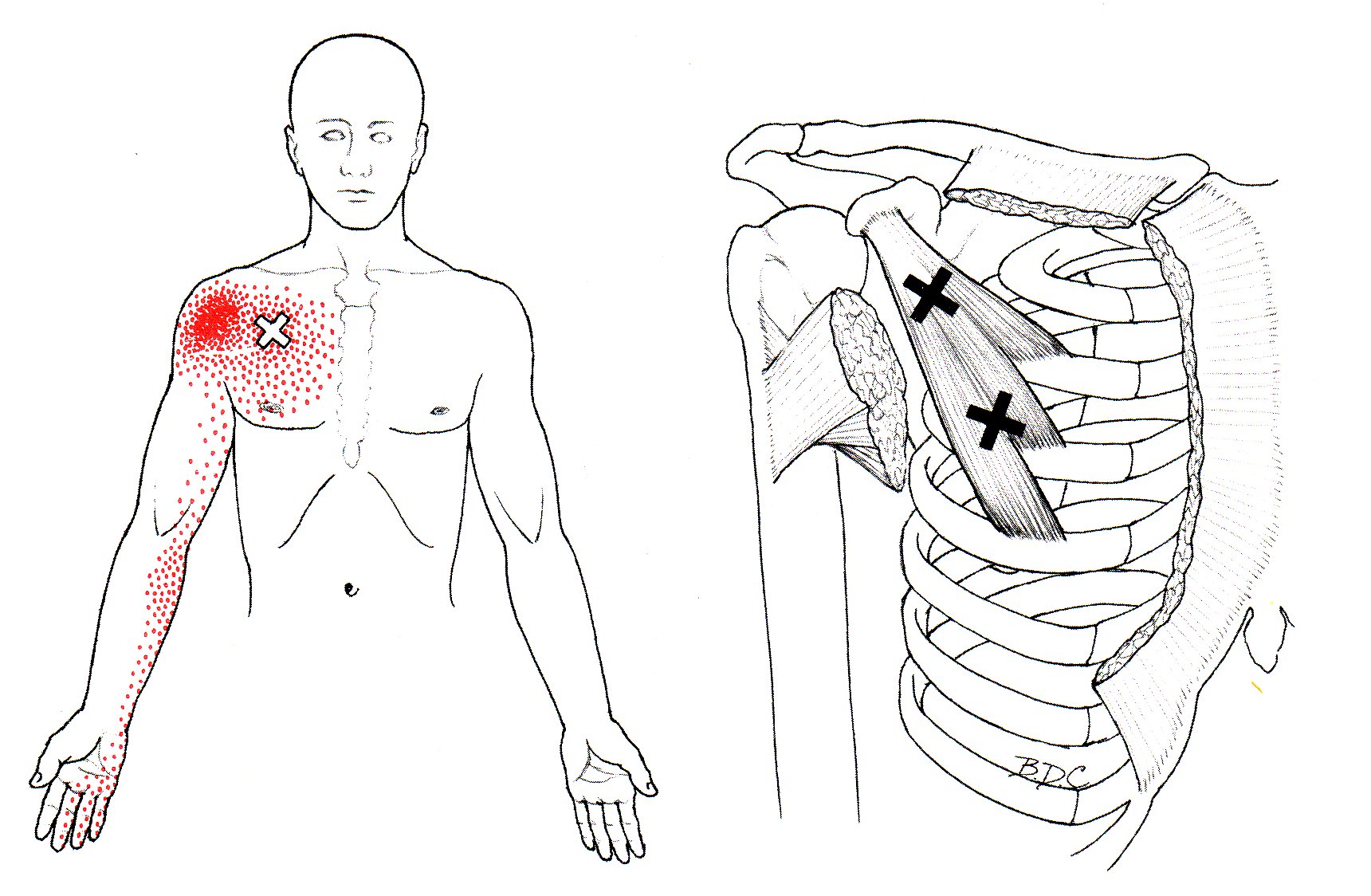Pectoralis Minimus | The Trigger Point & Referred Pain Guide
